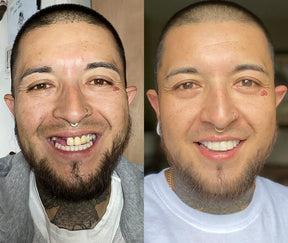 Lentille Dentaire White® - Kit Supérieur + Inférieur (TOTALEMENT AJUSTABLE À TOUTES LES ARCADES DENTAIRES)